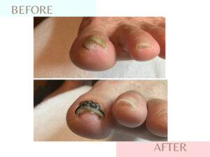 ツメフラ法を用いた巻き爪矯正の効果を示した写真