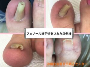 フェノール法手術をされた症例写真