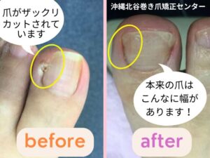 皮膚科で巻き爪をカットされただけの症例写真