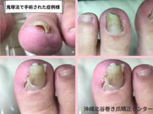鬼塚法で巻き爪手術されたお客様