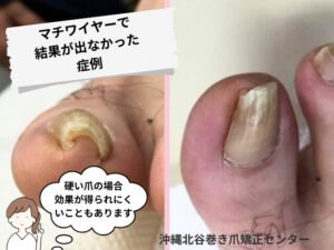 マチワイヤーで巻き爪矯正の結果が出なかった症例写真