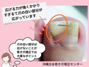 広げる力が強くかかりすぎて爪の白い部分が広がっている症例