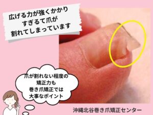 ワイヤーの広げる力が強すぎて爪が割れてしまっている症例
