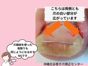 ワイヤーで広げる力が強くかかり、必要以上に爪が広がっている症例