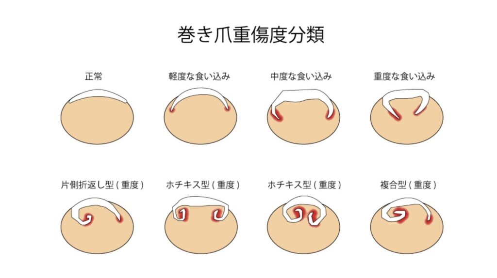 巻き爪の重症度分類