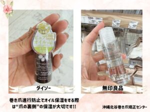 巻き爪の進行予防に保湿が有効です